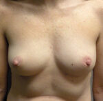 Breast Reconstruction