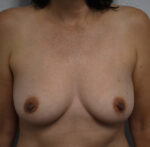 Breast Reconstruction