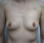 Breast Reconstruction