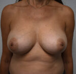 Breast Reconstruction