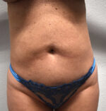 Tummy Tuck