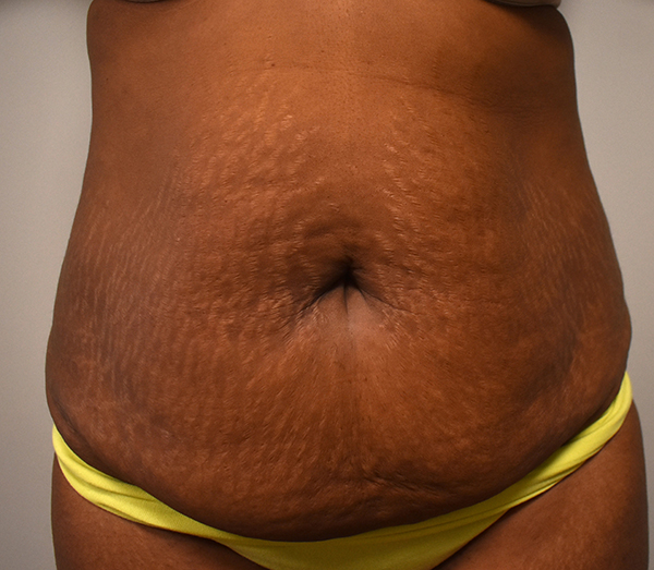 Tummy Tuck