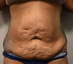 Tummy Tuck
