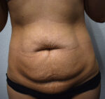 Tummy Tuck