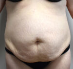 Tummy Tuck