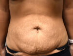 Tummy Tuck