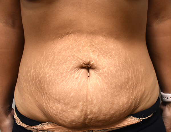front-view-before-tummy-tuck Tummy Tuck