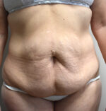 Tummy Tuck