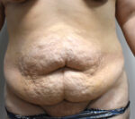 Tummy Tuck