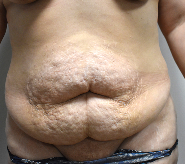 front-view-before-tummy-tuck Tummy Tuck