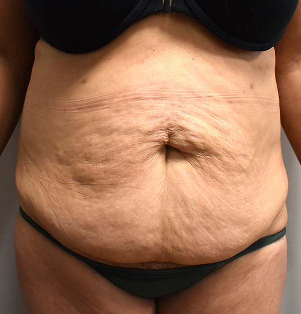 Tummy Tuck