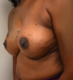 Breast Augmentation