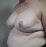 Breast Reconstruction