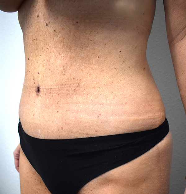 Tummy Tuck