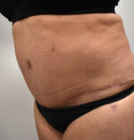 Tummy Tuck