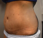 Tummy Tuck