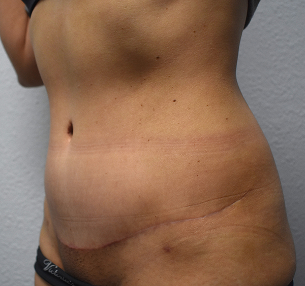 Tummy Tuck