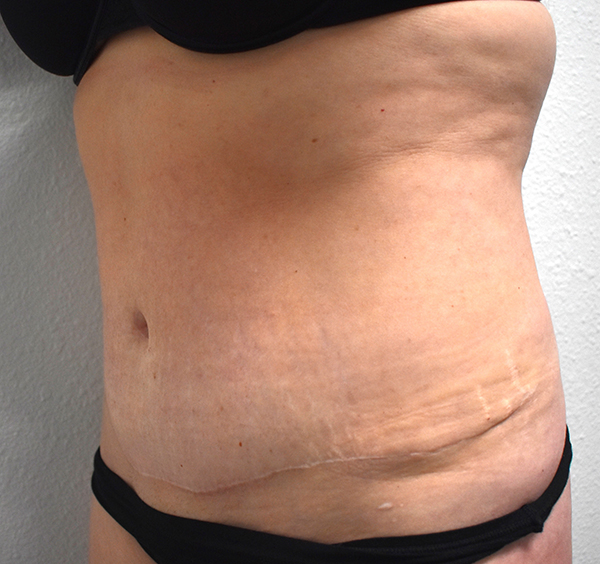 Tummy Tuck