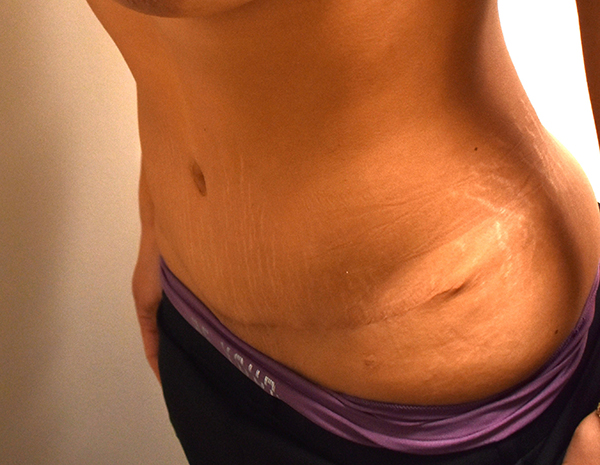 Tummy Tuck