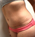 Tummy Tuck