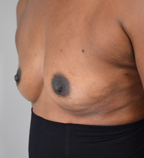 Breast Augmentation