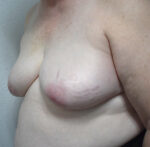 Breast Reconstruction
