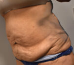 Tummy Tuck