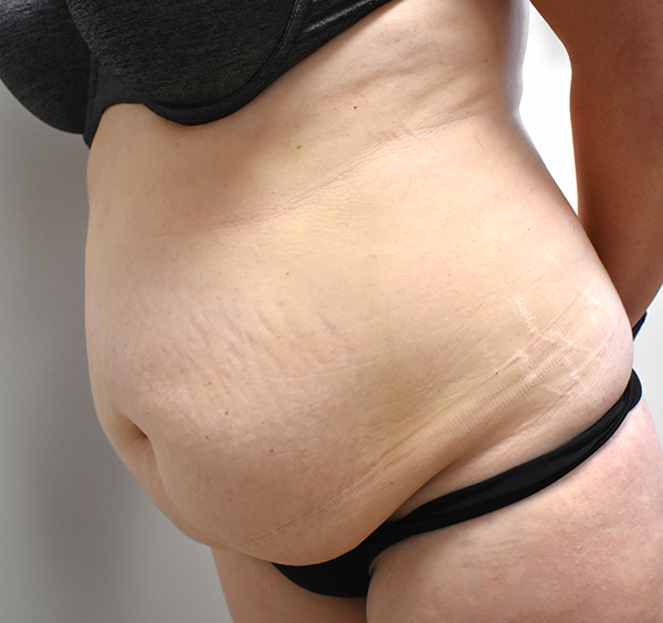 Tummy Tuck