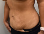Tummy Tuck