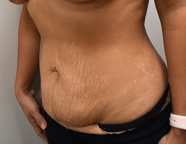 Tummy Tuck
