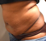 Tummy Tuck