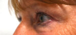Blepharoplasty