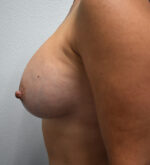 Breast Augmentation