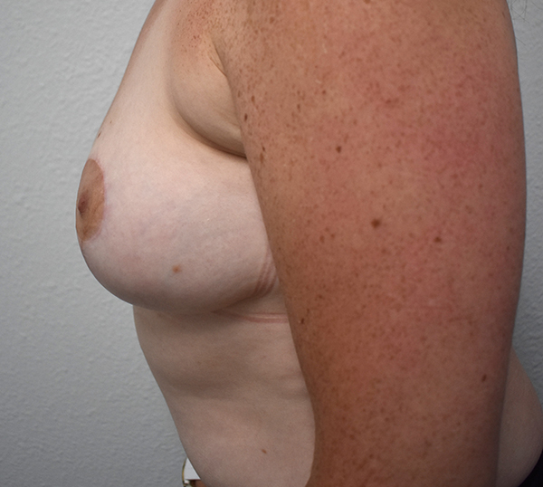 Breast Lift