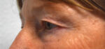 Blepharoplasty