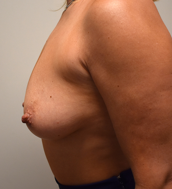 Breast Augmentation