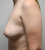 Breast Augmentation