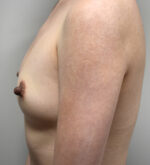 Breast Augmentation