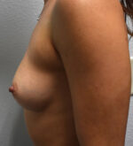 Breast Augmentation