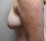 Breast Lift
