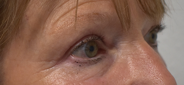 Blepharoplasty