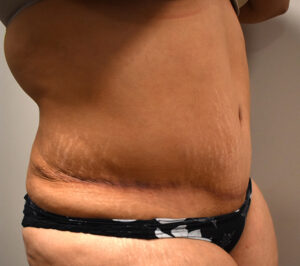 right oblique view after tummy tuck 1