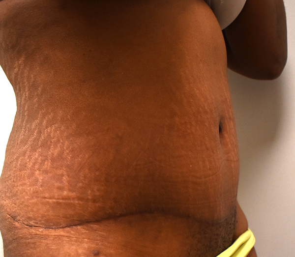 Tummy Tuck