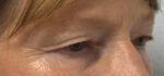 Blepharoplasty