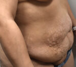 Tummy Tuck