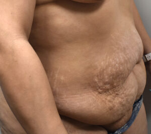 right oblique view before tummy tuck 1