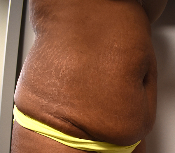 Tummy Tuck