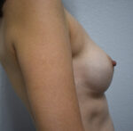 Breast Reconstruction