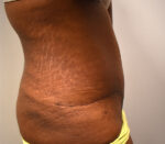 Tummy Tuck