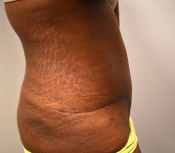 Tummy Tuck